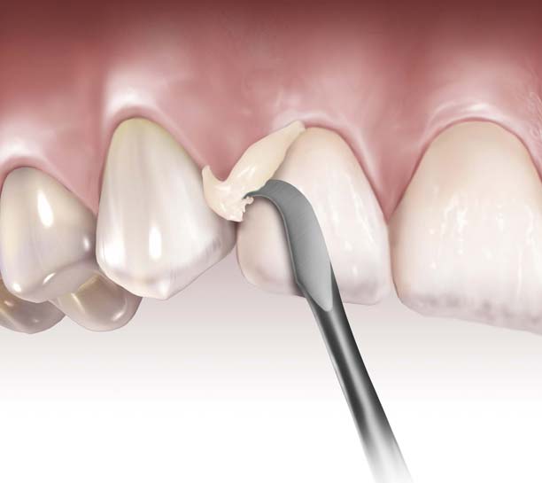 Waldent Manipal Hand Scalers Set of 3 15/2     