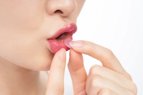 Curatick Oral Wound Dressing (Pack of 10) (Short Expiry 06-2026)