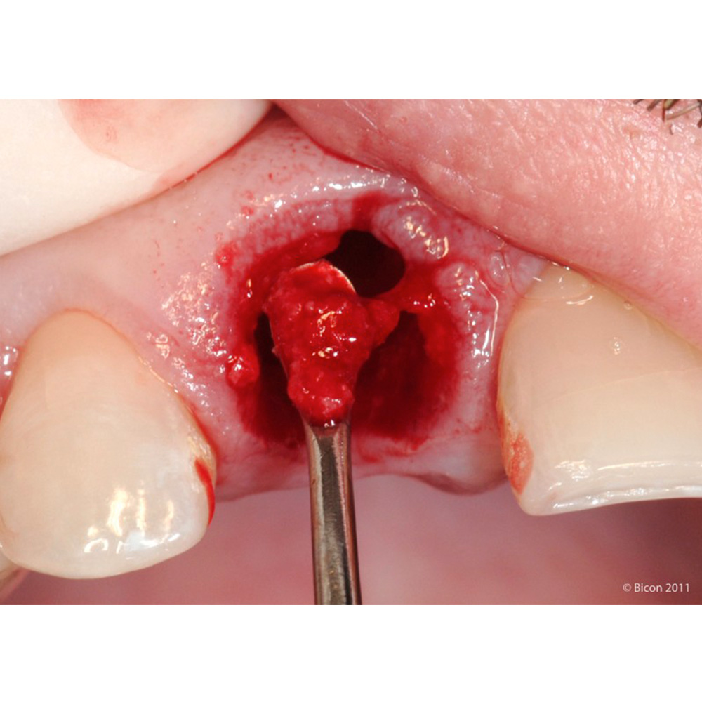 GDC Lucas Surgical Curettes