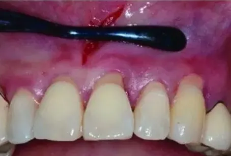 Waldent Vista Tunneling Procedure Instrument