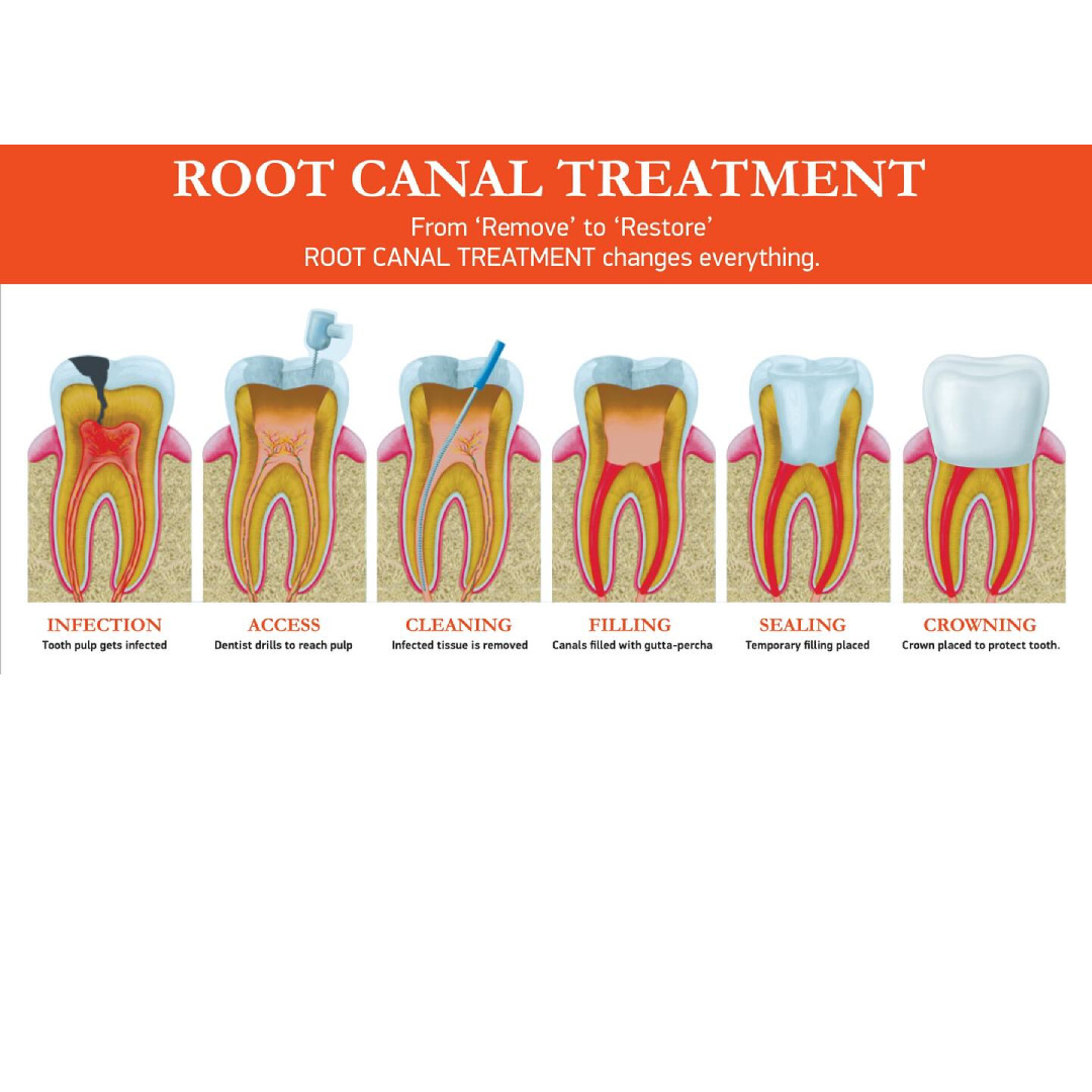 SafeEndo BioActive 3D