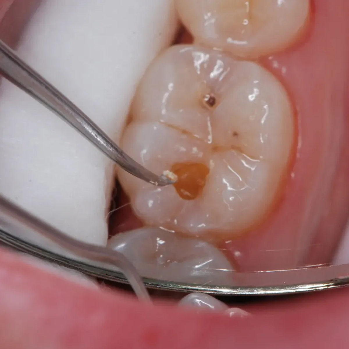 Waldent Spoon Excavators Oval Shape