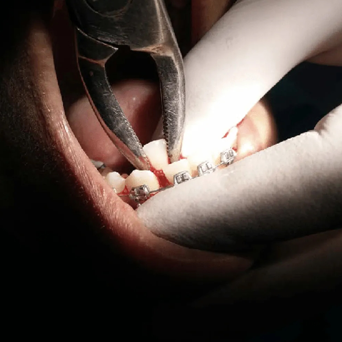 Medesy Upper Premolars And Canines Extraction Forceps - Deep Grip (2500/181)