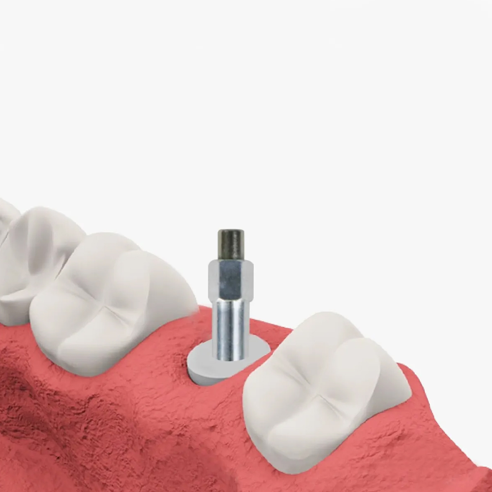 DentalPlant Dio-UFII Regular | Wide Compatible SmartPeg - 2.5mm Hex