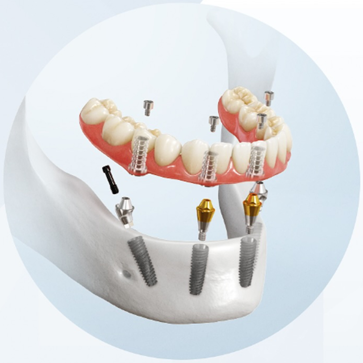 Dentaltech Korean Implant Compatible Multi Unit Straight Abutments