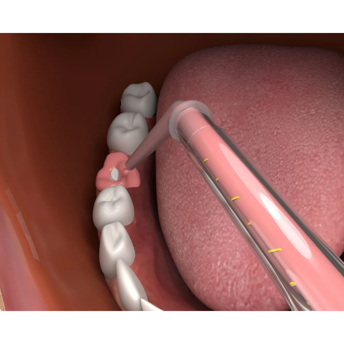 Seil Global Impression Saver Syringe & Dispensing Gun Combo