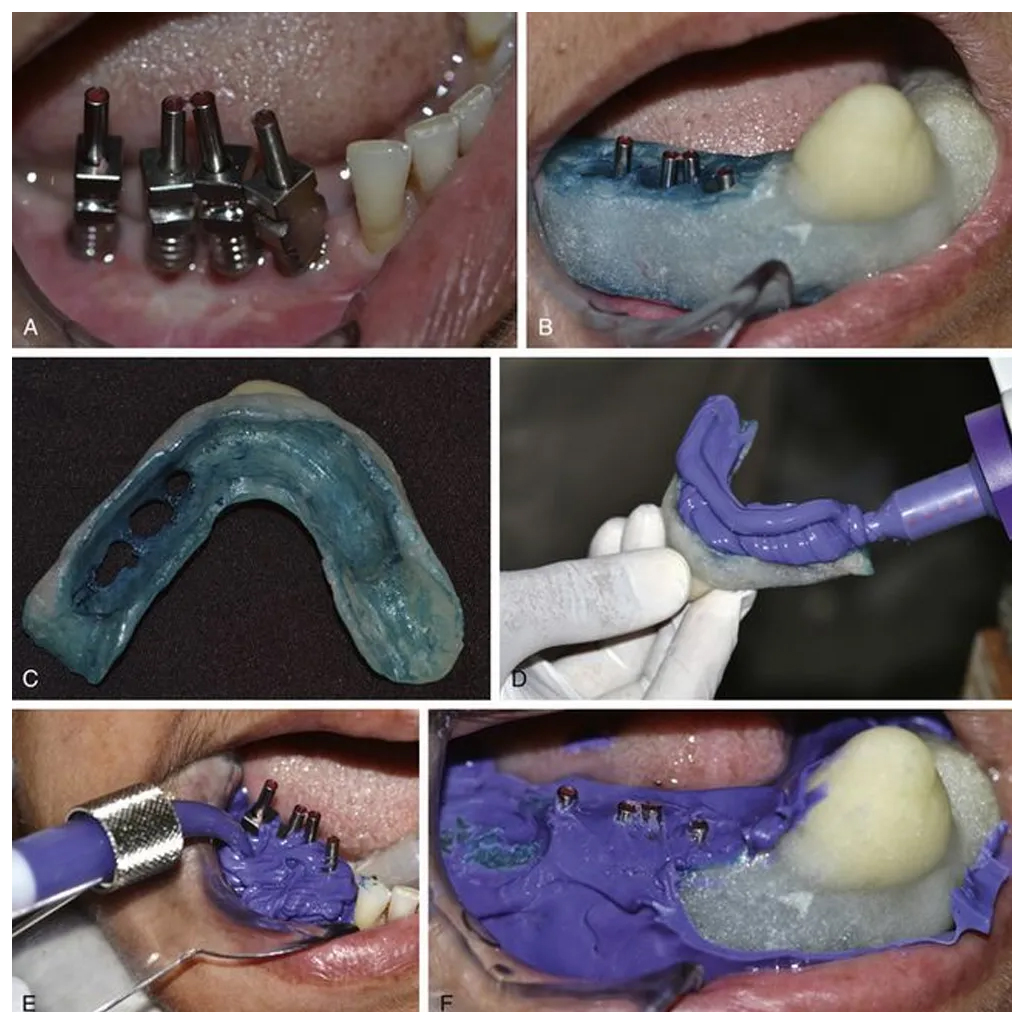 Dentaltech Korean | Israeli | Nobel | Straumann Implant Compatible Multi Unit Open Tray Impression Coping ∅4.8mm X 11mm (FHZYG)