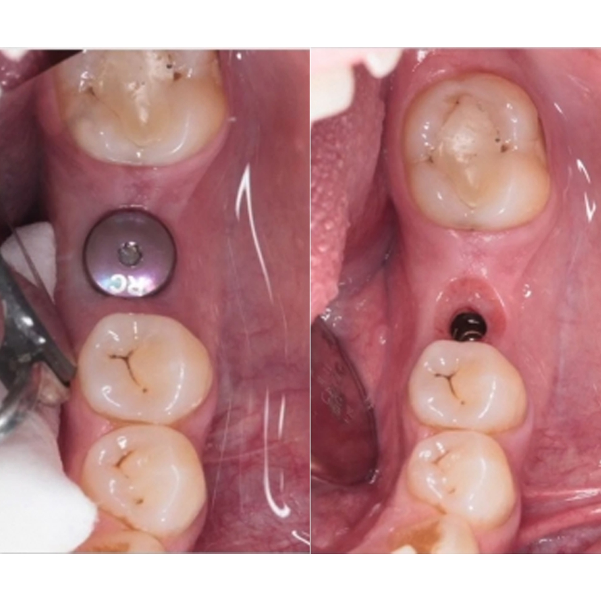 Dentaltech Straumann RC Implant Compatible Healing Abutments