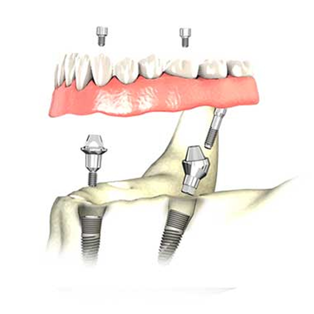 Dentaltech Korean Implant Compatible Multi Unit Angular Abutments - Regular