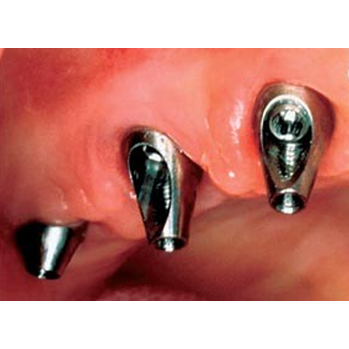 Dentaltech Israeli Implant Compatible 15°Angular Abutments RS