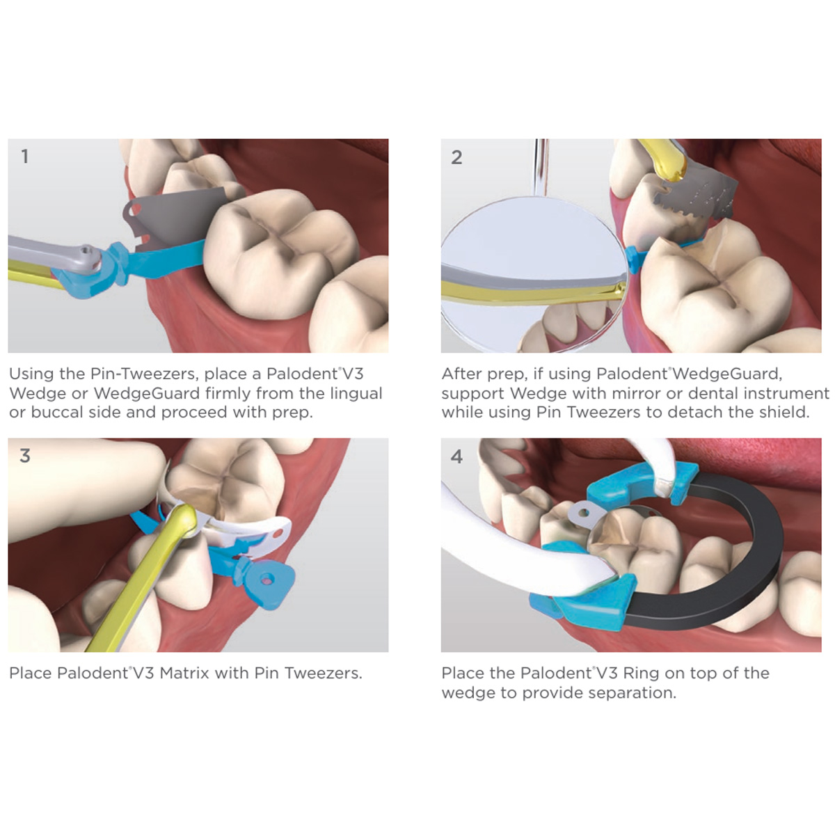 Dentsply Palodent V3 Wedge Guards Refills (Pack Of 50)