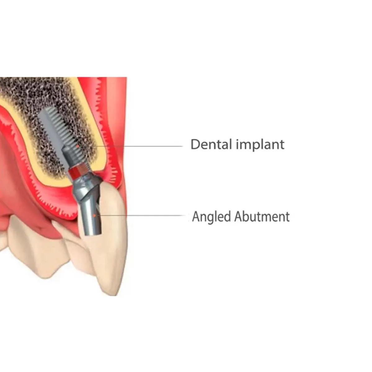 Dentaltech Israeli Implant Compatible 15°Angular Abutments RS