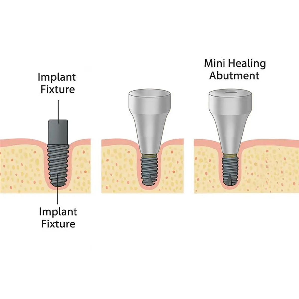 Dentaltech Korean Implant Compatible Healing Abutments - Mini