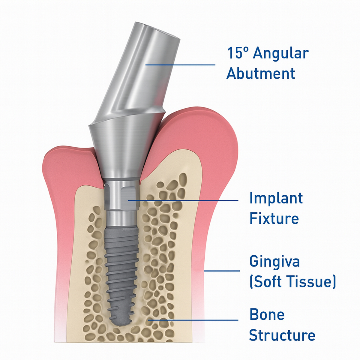 Dentaltech Straumann RC Implant Compatible 15° Angular Abutments