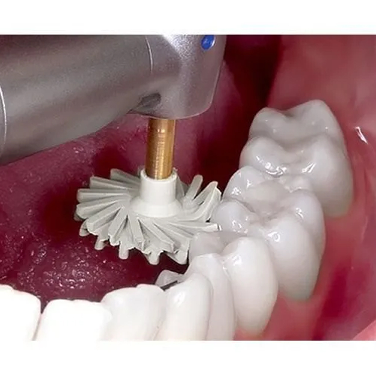 Youdent Composite Polishing Assorted Kit RA (TR0305)