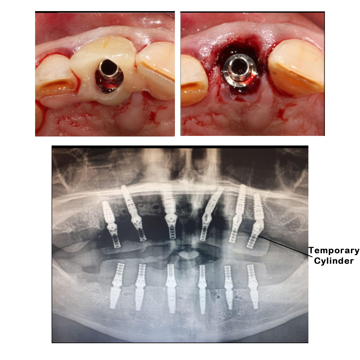 Dentaltech Korean | Israeli | Nobel | Straumann Implant Compatible Multi Unit Temporary Cylinder (FHTJD)
