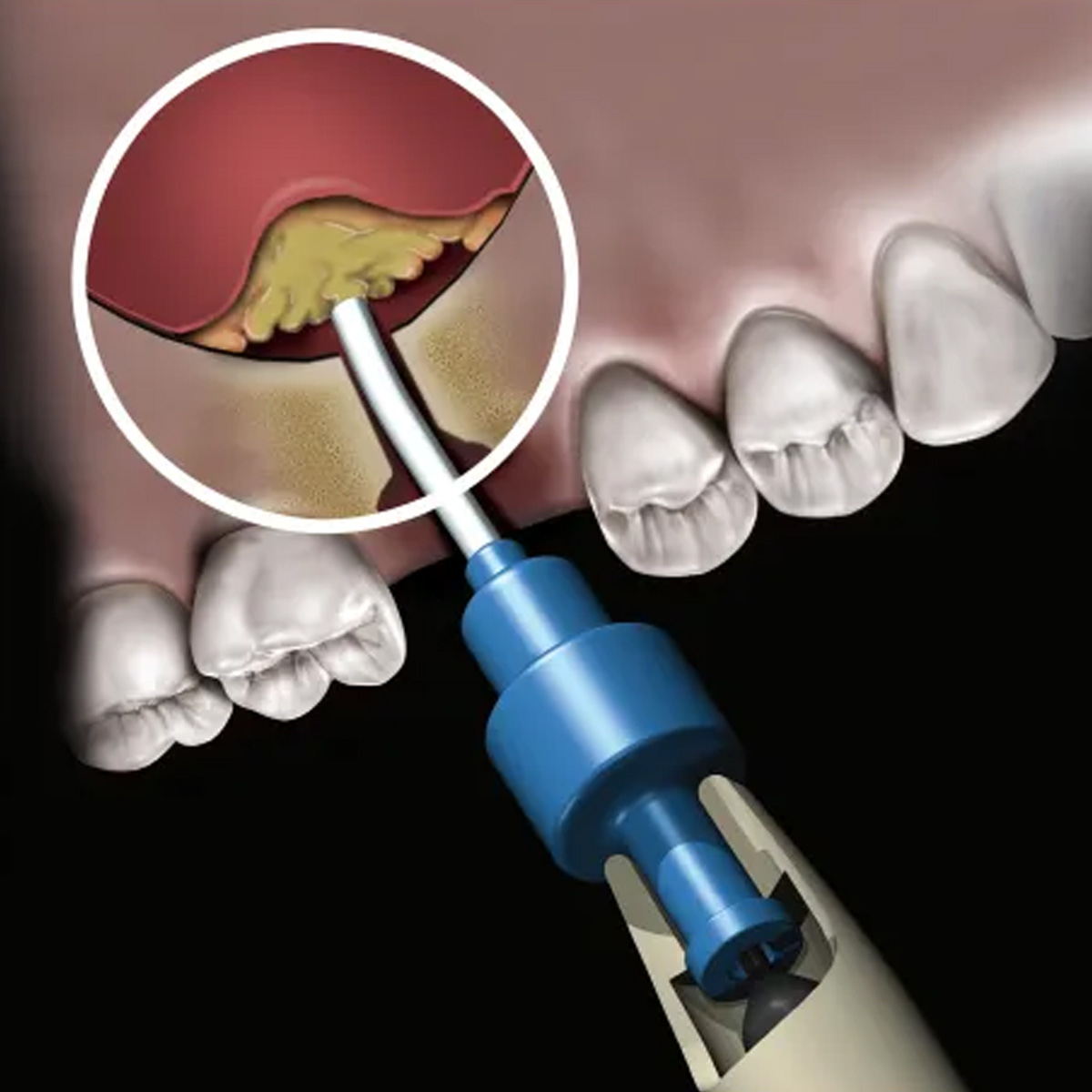 Novabone Dispensing Gun For Bone Graft Putty Cartridge