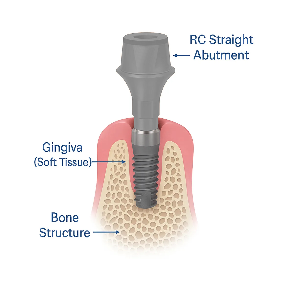 Dentaltech Straumann RC Implant Compatible Straight Abutments