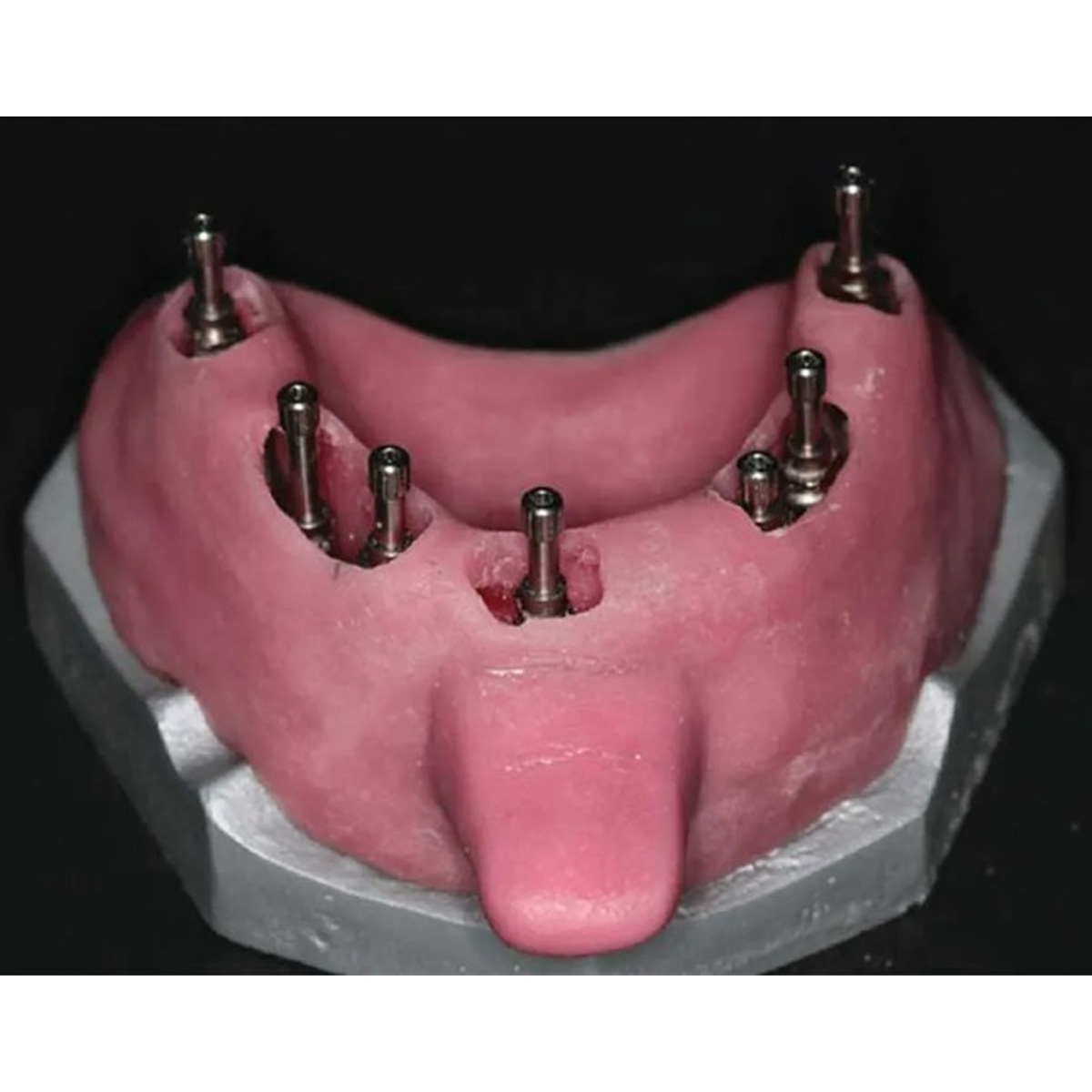Dentaltech Korean Implant Compatible Open Tray Impression Coping