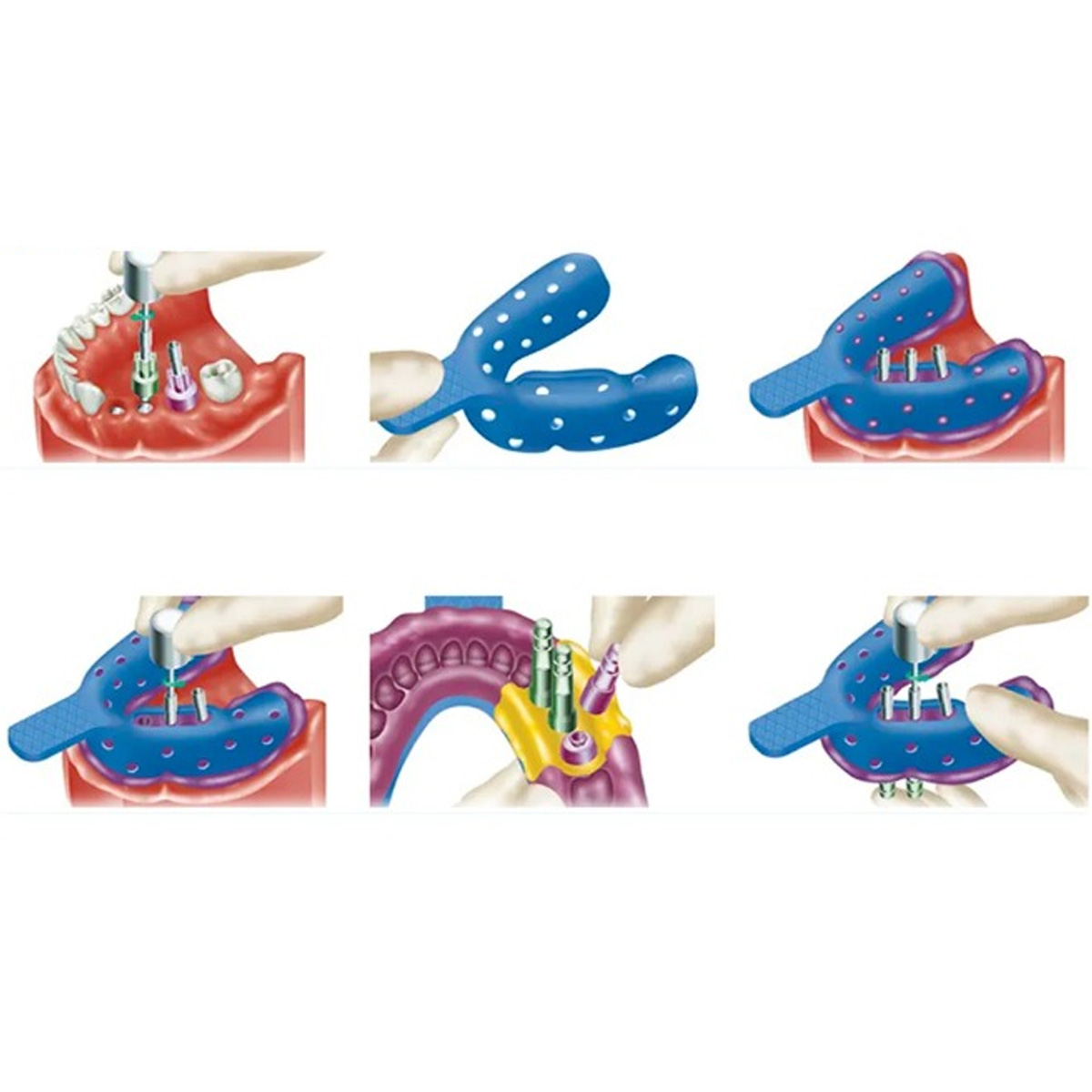 Dentaltech Korean Implant Compatible Open Tray Impression Coping