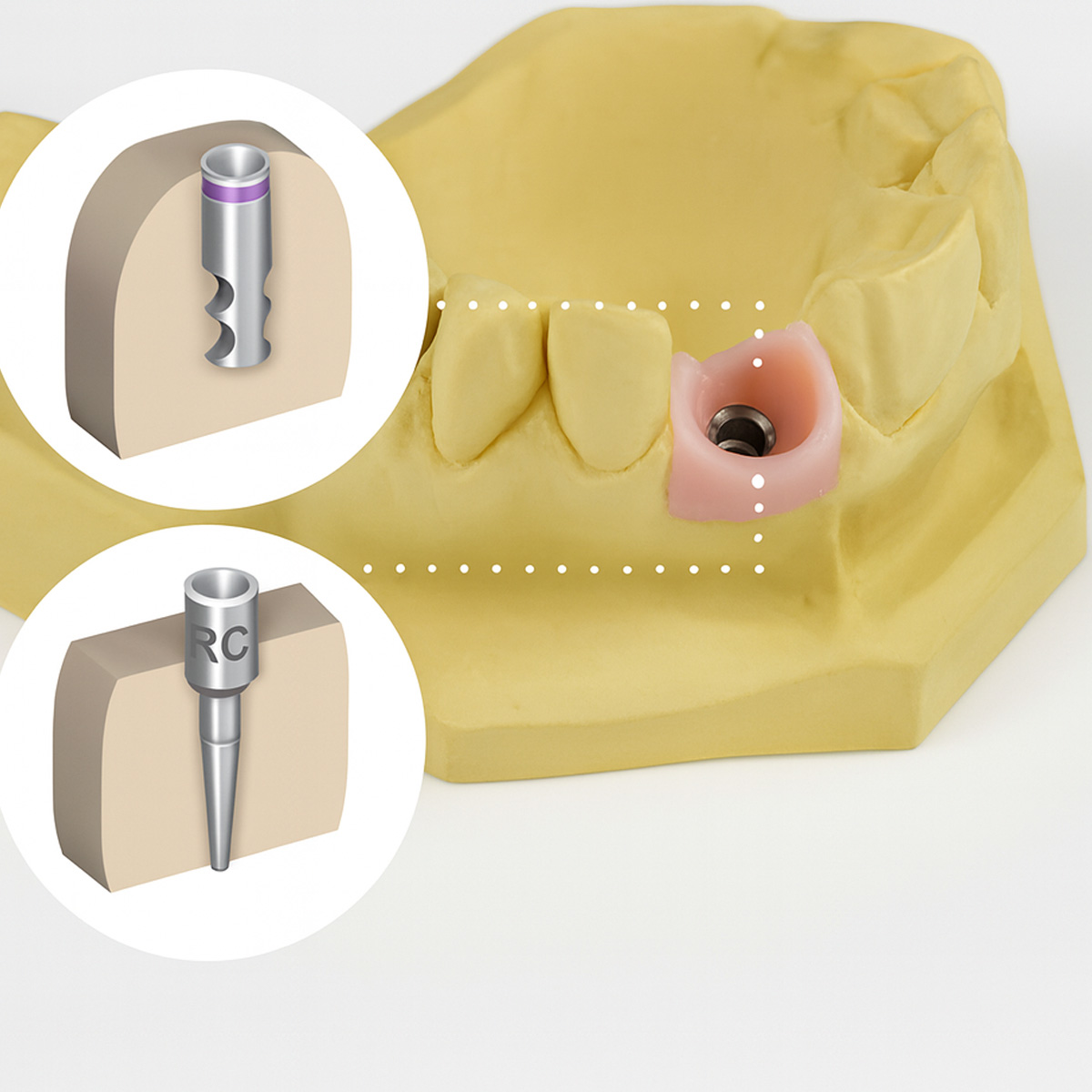 Dentaltech Straumann RC Implant Compatible Lab Analog ∅4.0mm (ITI-RC 025.4101)