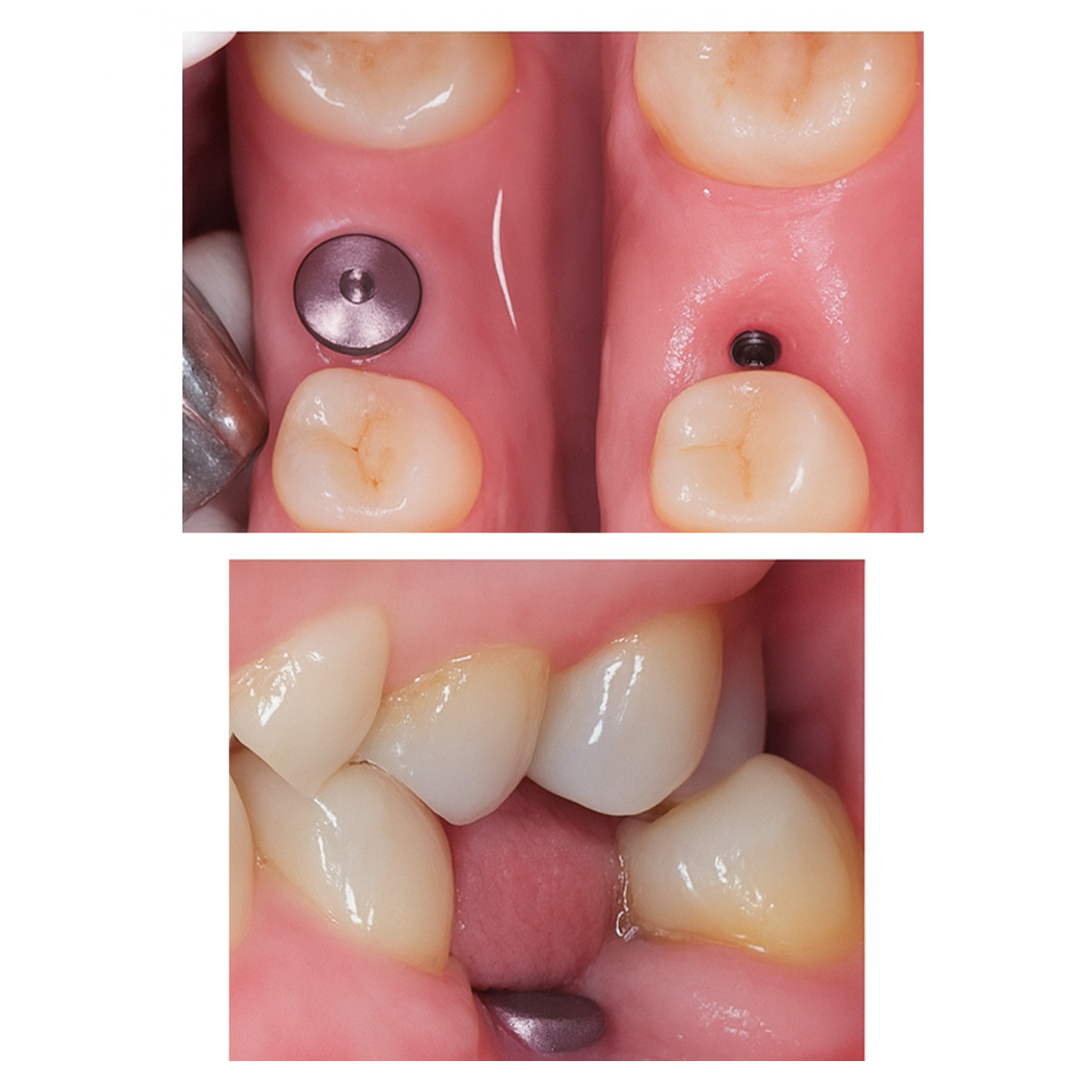 Dentaltech Straumann RC Implant Compatible Healing Abutments
