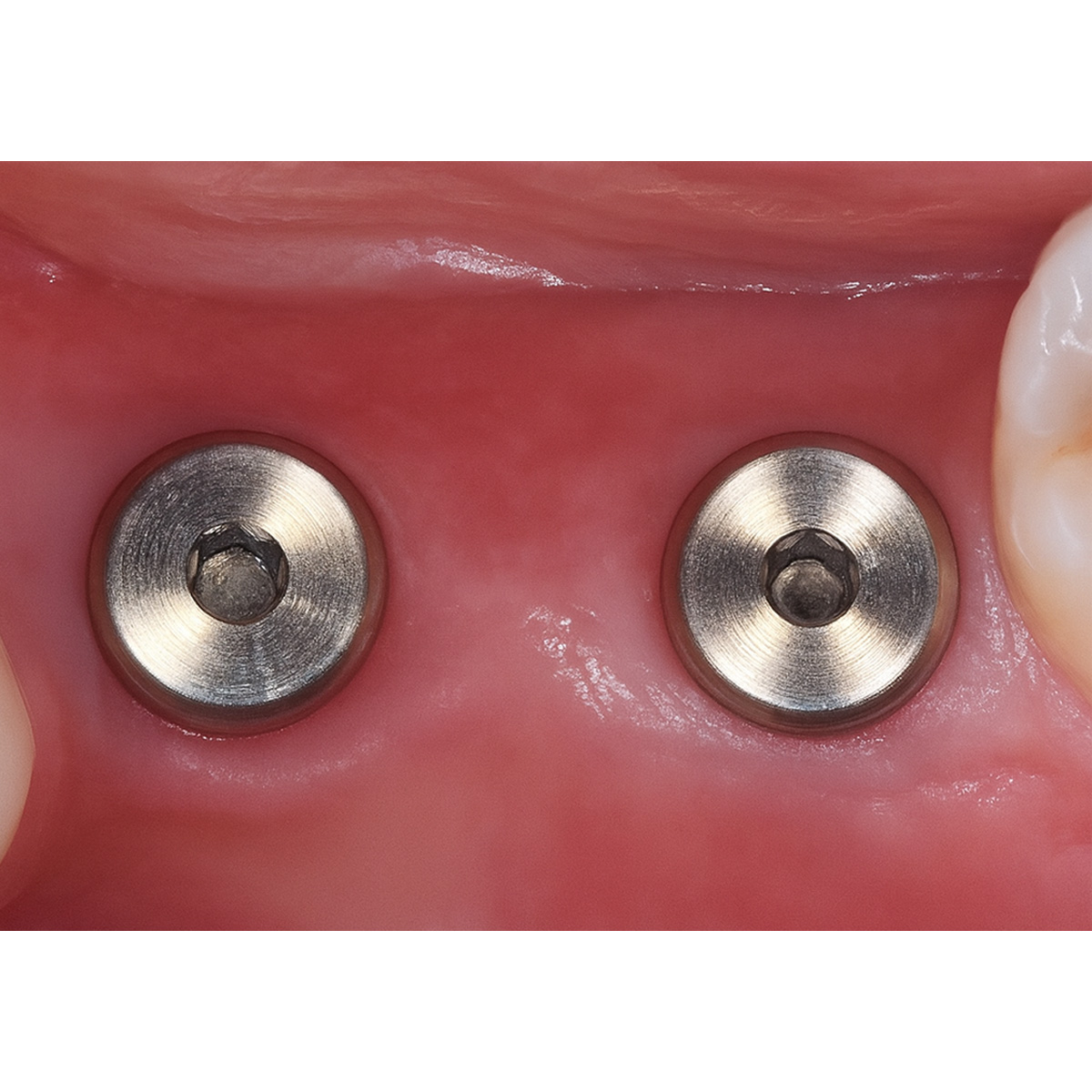 Dentaltech Nobel NP Implant Compatible Healing Abutments