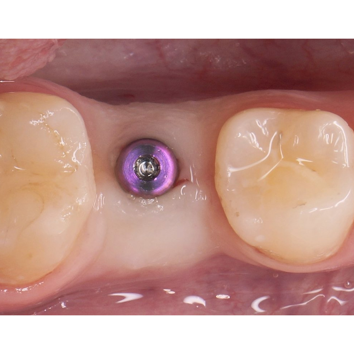 Dentaltech Straumann BLX Implant Compatible Healing Abutments