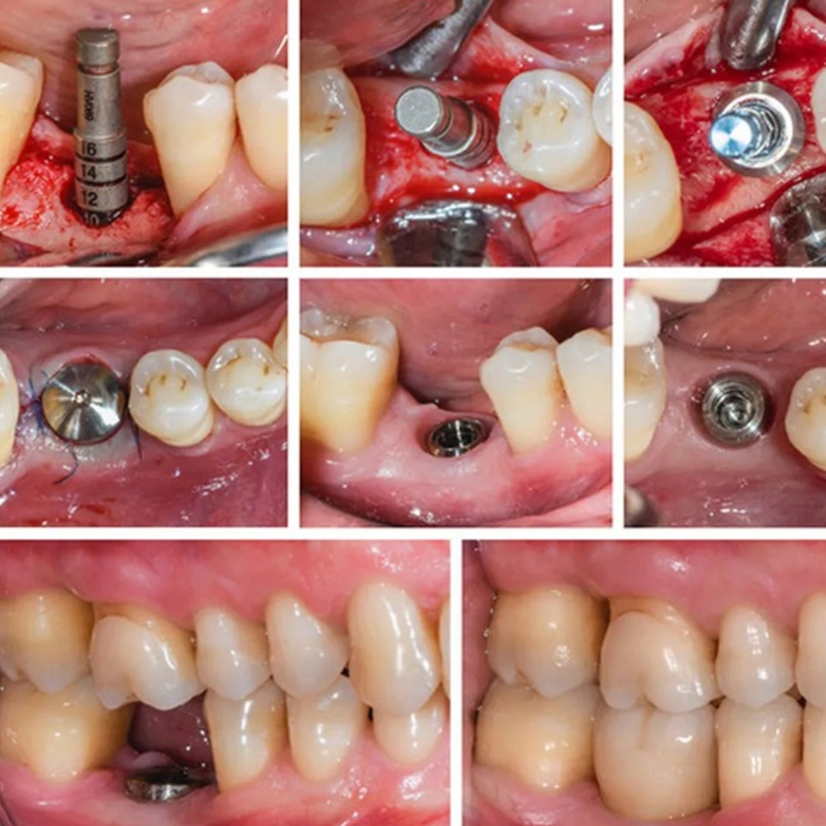 Dentaltech Nobel RP Implant Compatible Healing Abutments