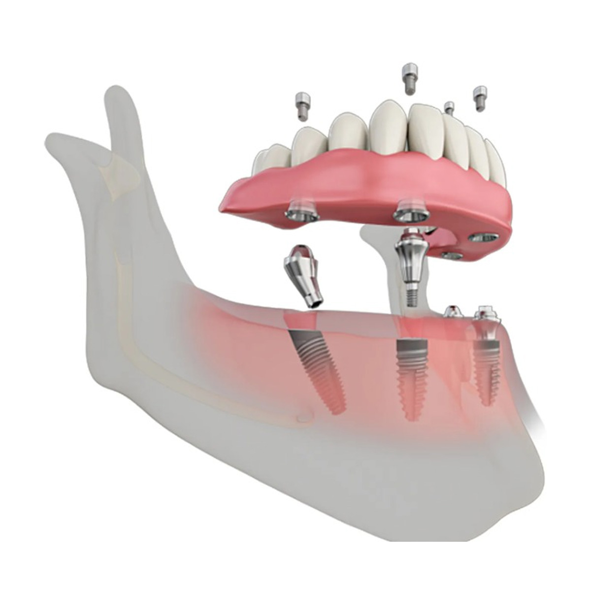 Dentaltech Israeli Implant Compatible Multi Unit Angular Abutments RS