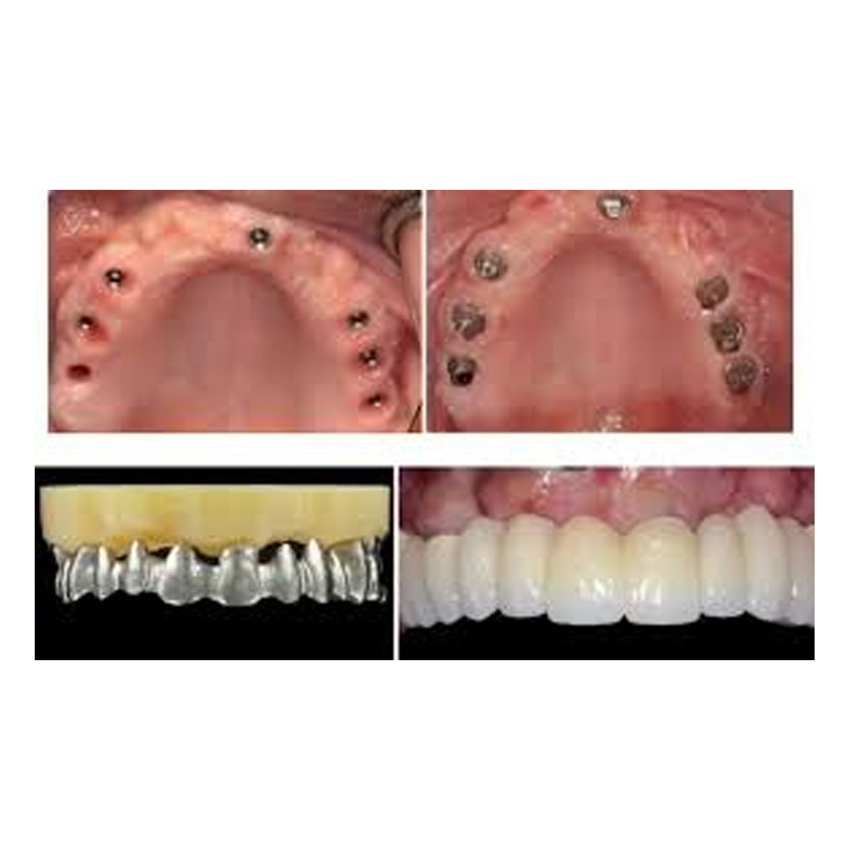 Dentaltech Israeli Implant Compatible Multi Unit Straight Abutments RS