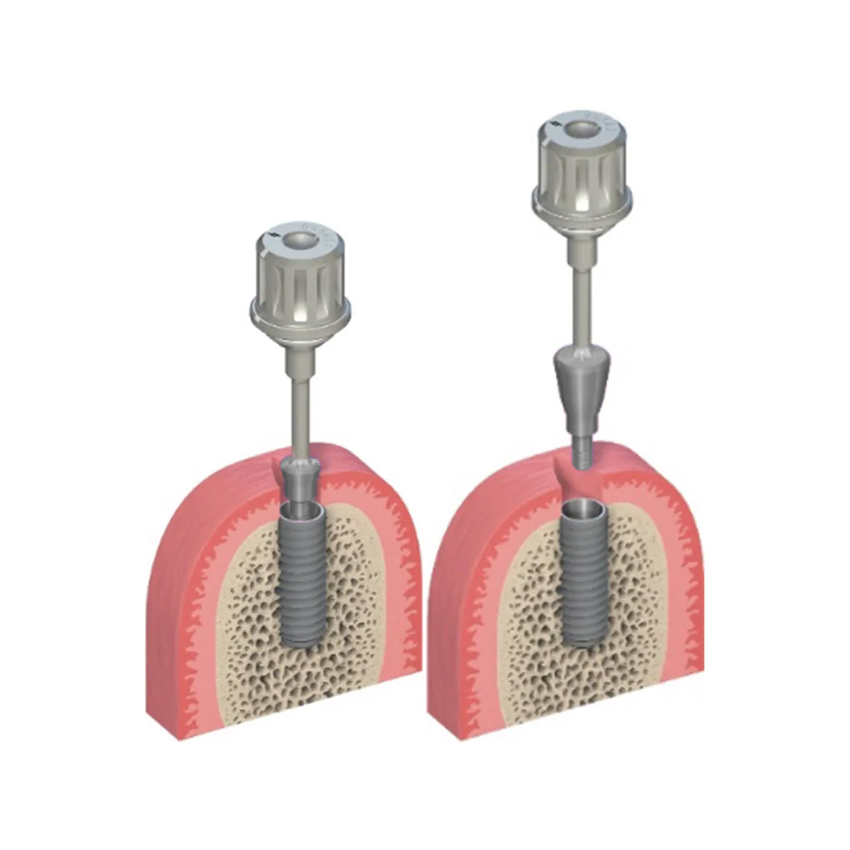 Dentaltech Straumann RC Implant Compatible Healing Abutments