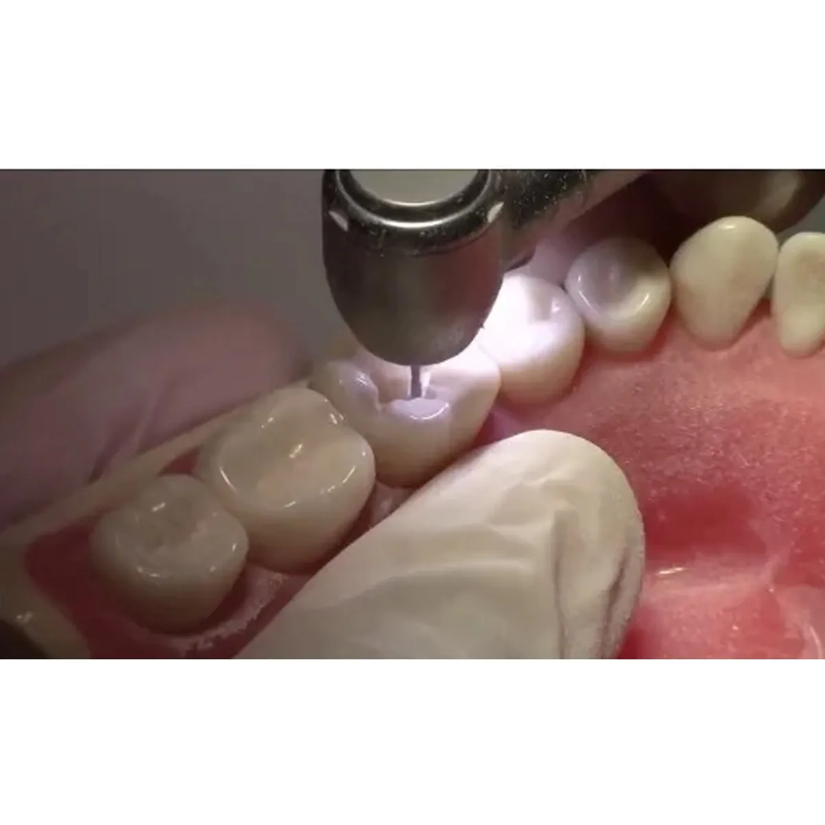 Being Foshan LED Airotor & Cartridge (401P-B2)