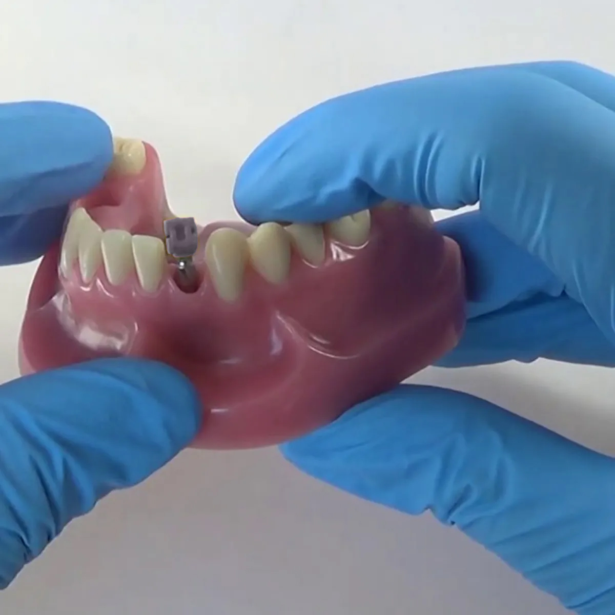 Dentaltech Straumann RC Implant Compatible Close Tray Impression Coping ∅4mm (ITI-RC 025.4201)