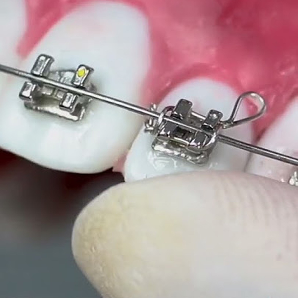 UU Ortho Kobayashi Ligature Wire Twisted Short 2.5cm (Pack of 100)