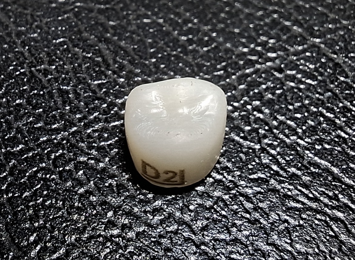 Pedo Crown Primary 1st Upper Molar Refills