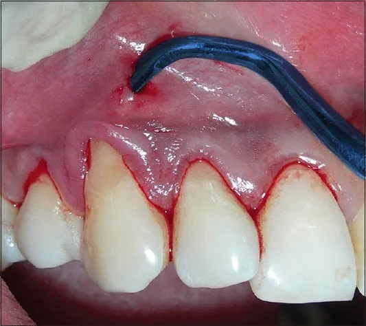 Waldent Vista Tunneling Procedure Instrument