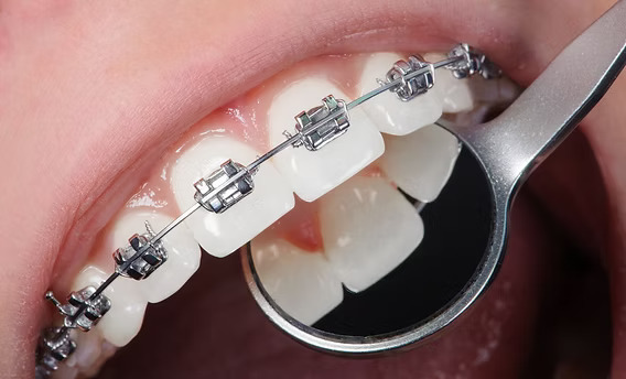 OSL Heat Activated NiTi Square Form Archwires - Square (Pack of 10)