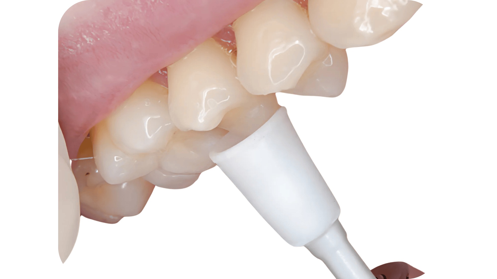 Youdent Silicone Polishers For Composite White (Pack Of 25)