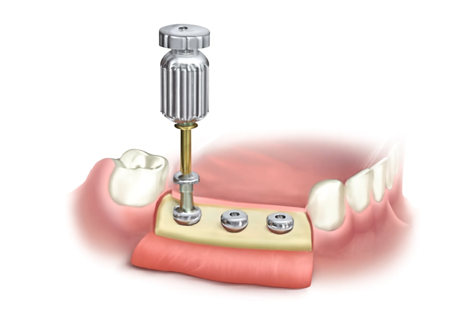Dentaltech Korean Implant Compatible Cover Screws