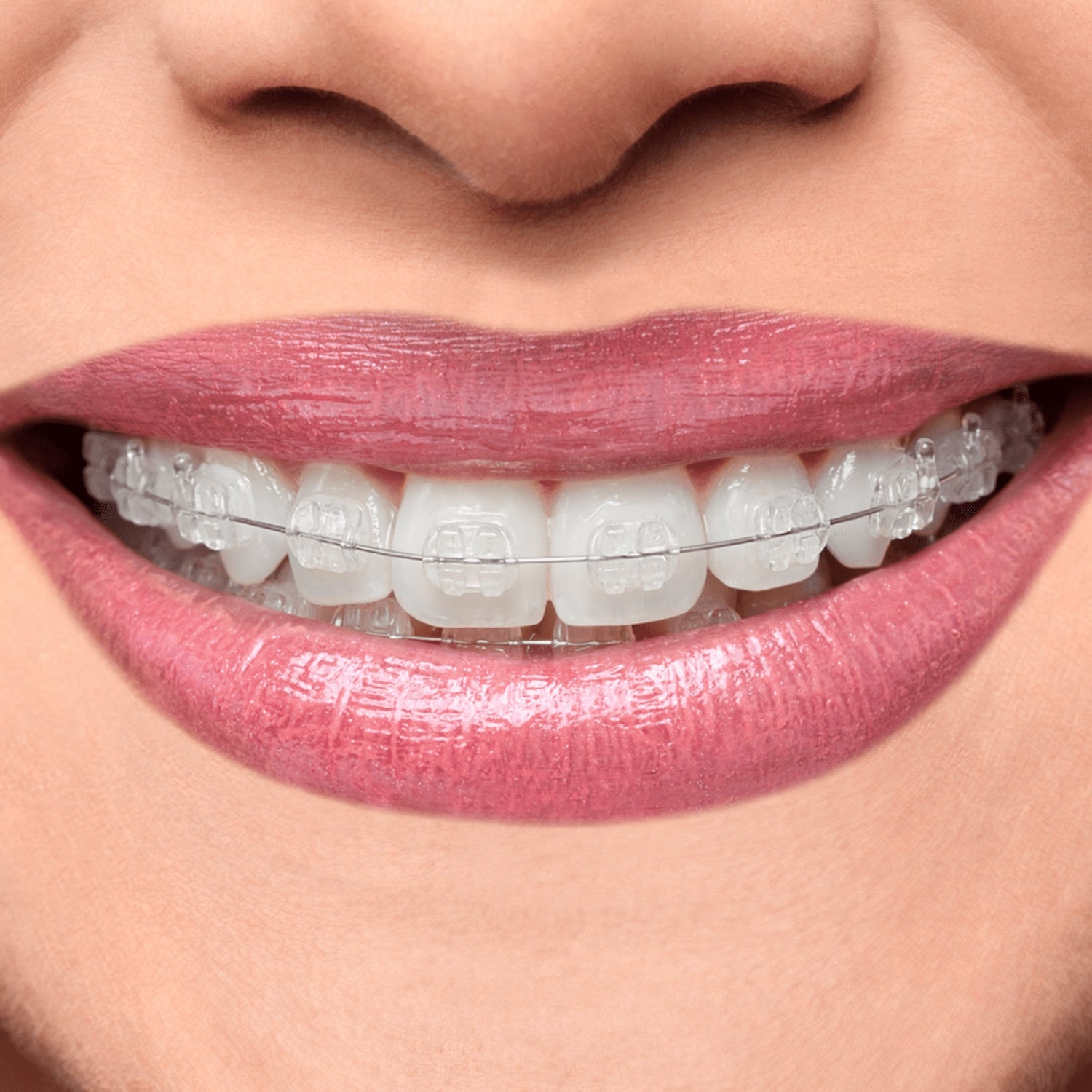 OrthoMetric Iceram-S Monocrystalline Ceramic Bracket MBT 022 - (10.91.2000)