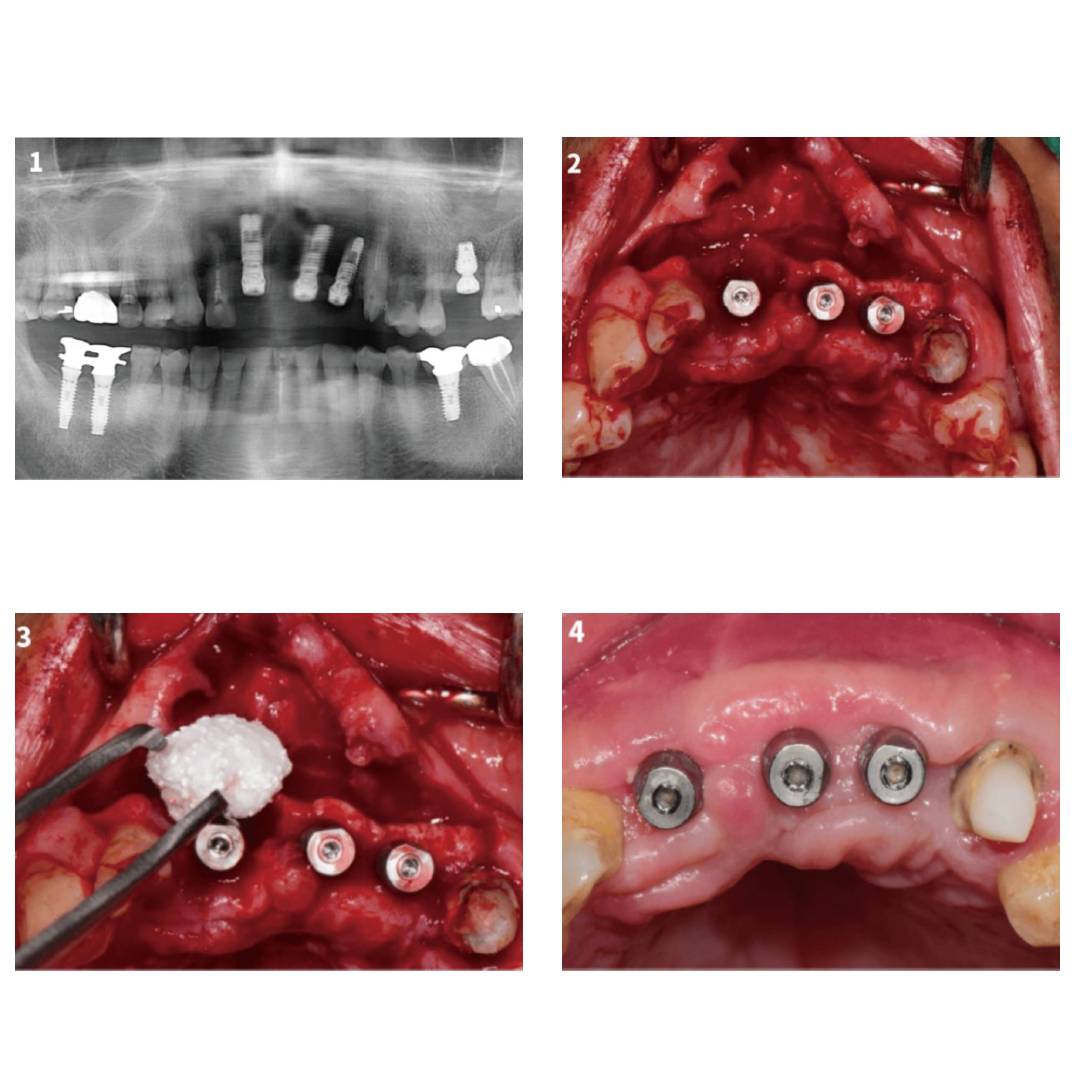 GC Flexceed Putty + Light Body Kit