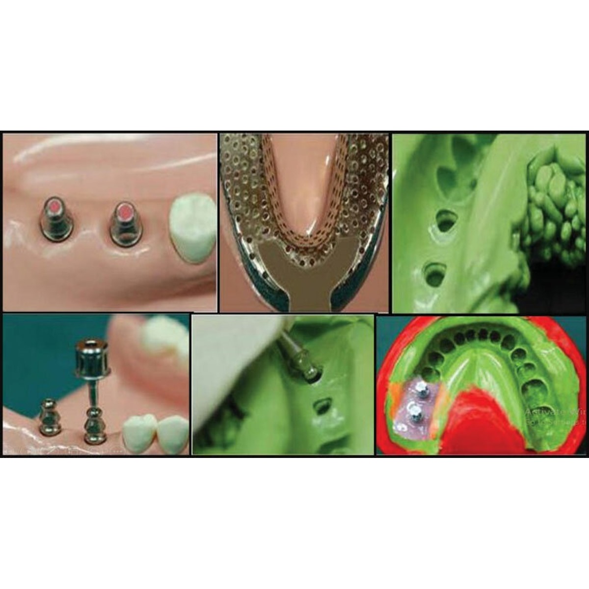 DentalTech Korean Implant Compatible Close Tray Impression Copings