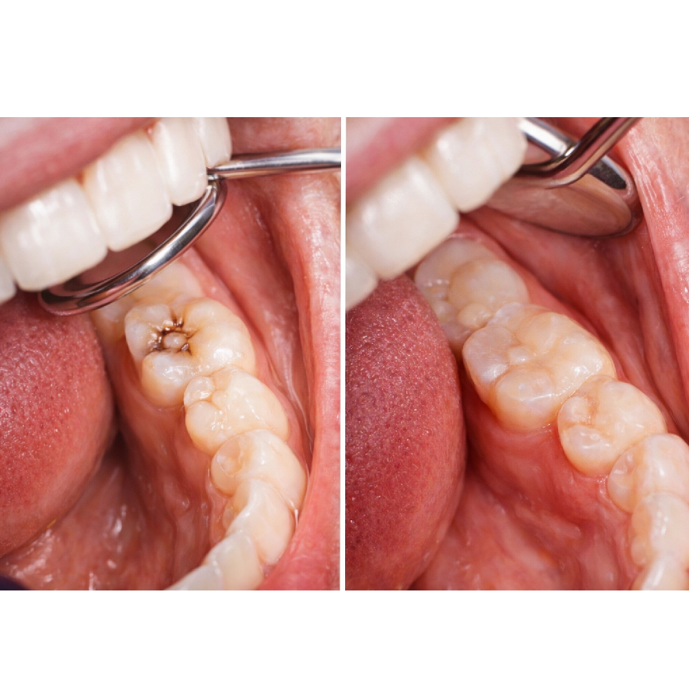 Ivoclar Tetric N Ceram Starter Kit with Tetric N Bond Universal 3g