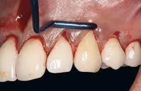 Waldent Vista Tunneling Procedure Instrument