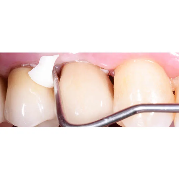 GC Gold Label 1 Glass Ionomer Mini Pack