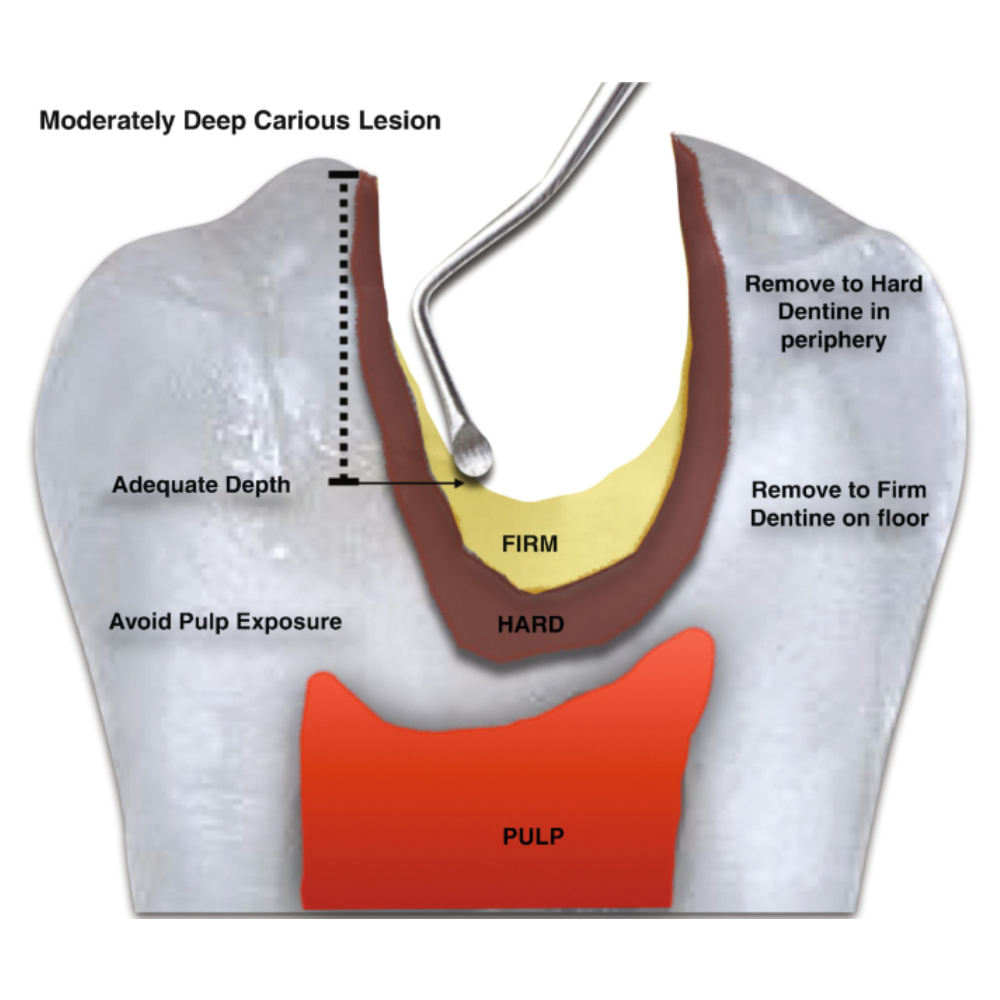 Waldent Spoon Excavator Hollow Handle 11L X 12L - (15/809)
