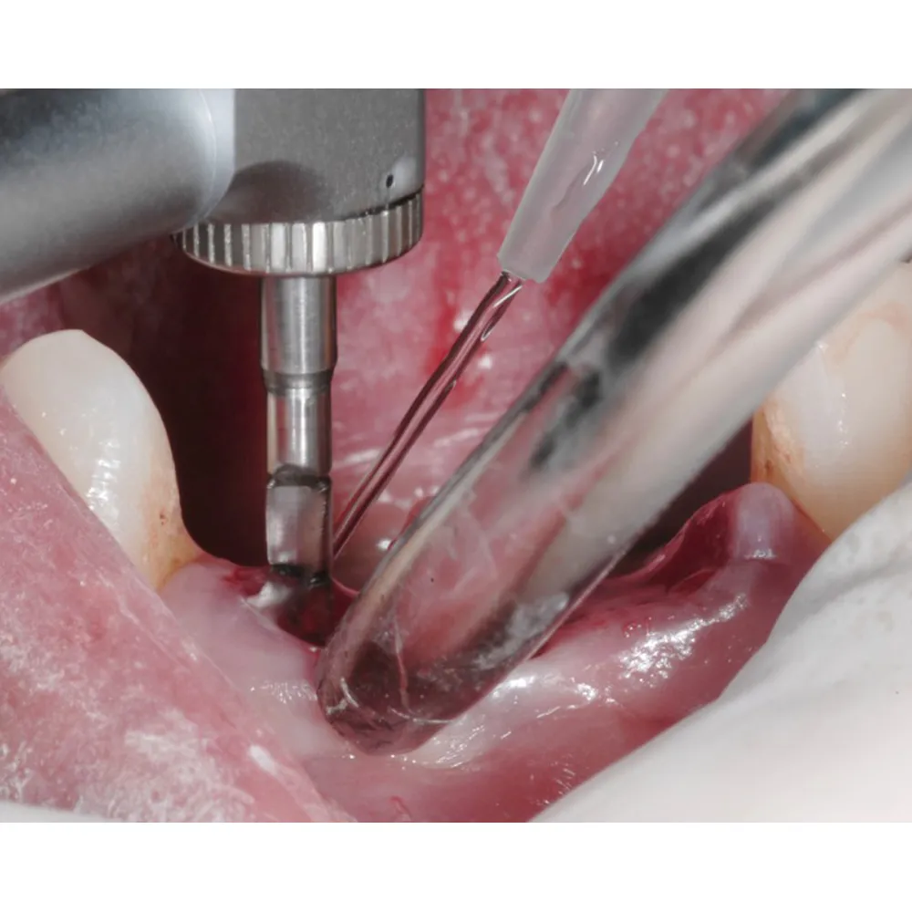 Woodpecker Implant Motor Irrigation Tubing