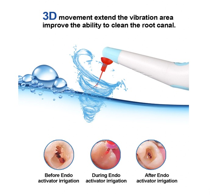 SuperEndo Tips For Sonic Irrigator (Pack of 10)