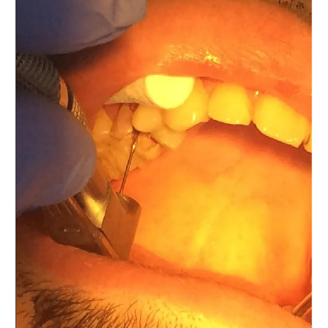 Mani Peeso Reamers 32mm